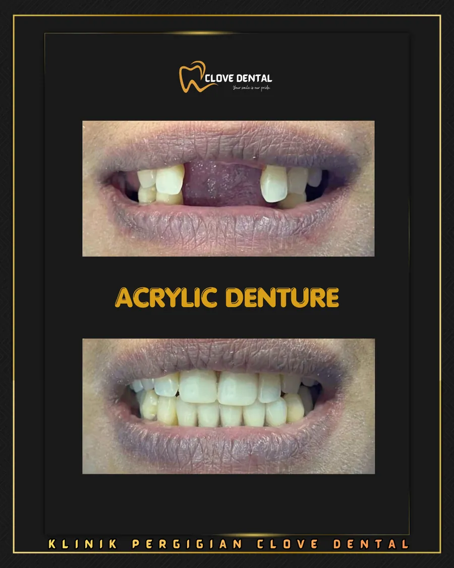 Before and after: acrylic denture at Clove Dental