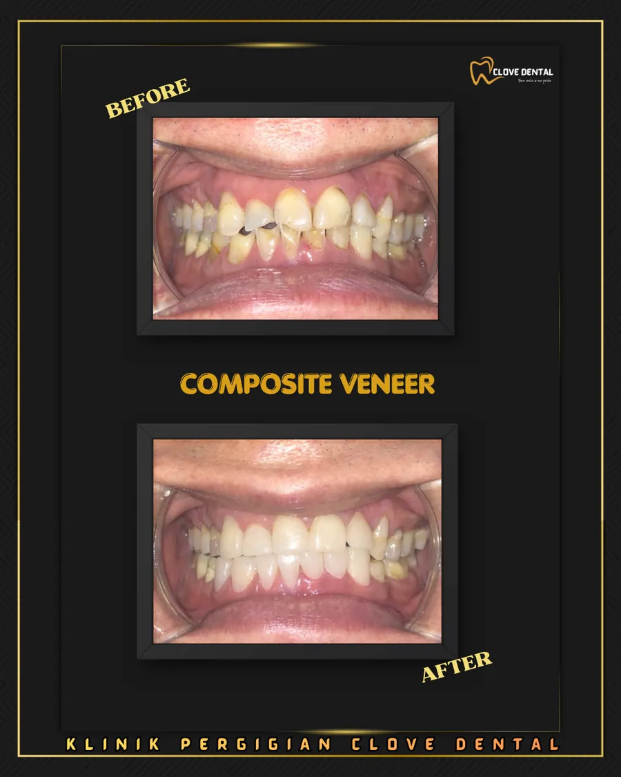 Before and after: composite veneers for worn teeth at Clove Dental