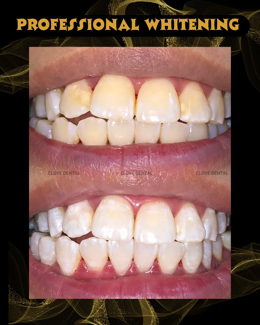 Before and after: professional teeth whitening at Clove Dental