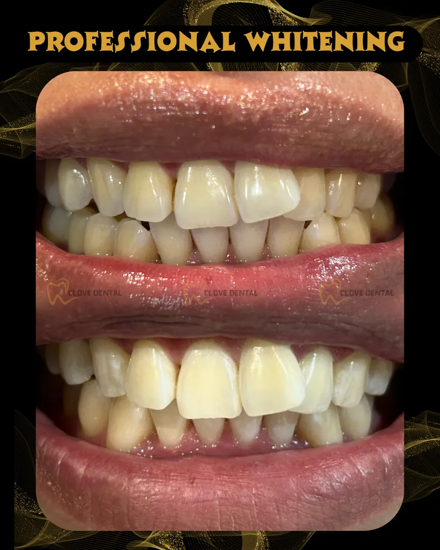 Before and after: professional whitening at Clove Dental